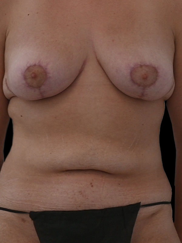 Nipple Sparing Reconstruction Before & After Image