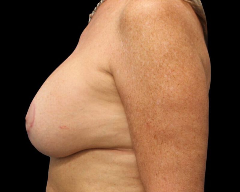 Augmentation Mastopexy Before & After Image