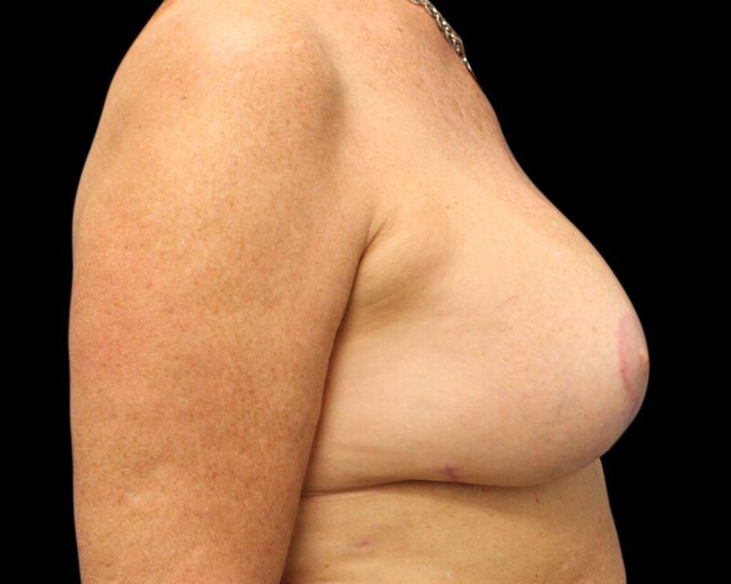 Augmentation Mastopexy Before & After Image