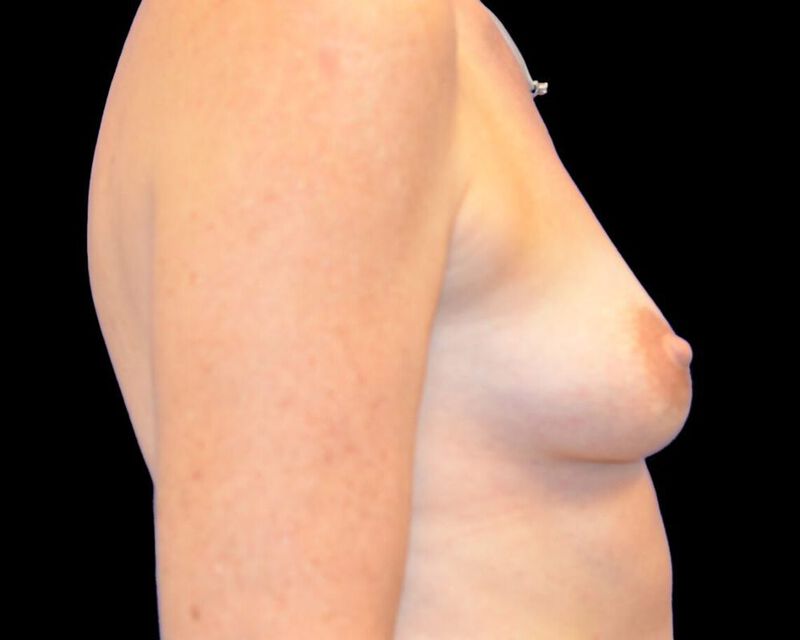 Breast Augmentation with Fat Transfer Before & After Image