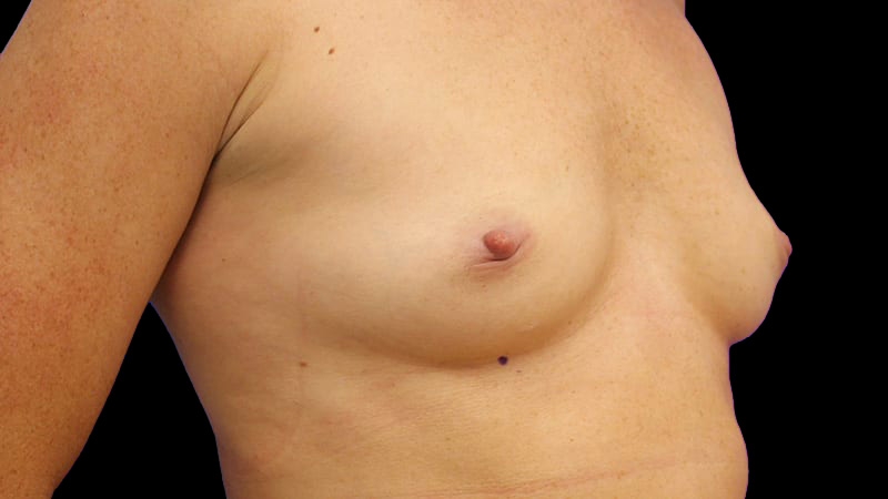 Breast Augmentation Before & After Image