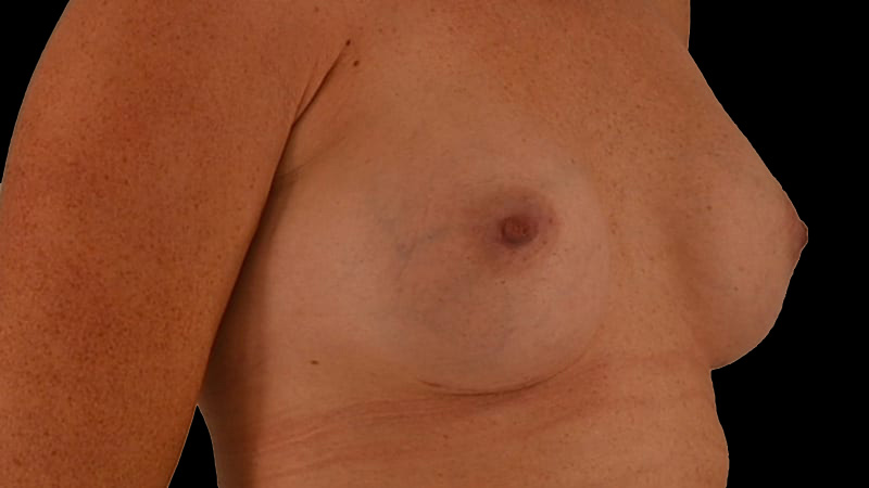 Breast Augmentation Before & After Image