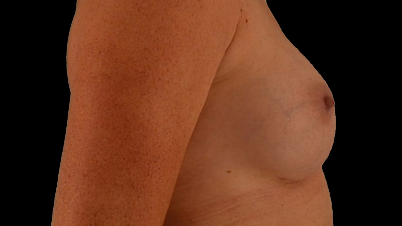 Breast Augmentation Before & After Image