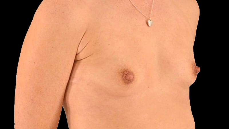 Breast Augmentation Before & After Image