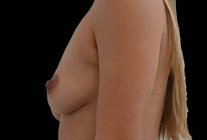 Breast Augmentation Before & After Image