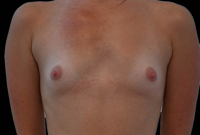 Breast Augmentation Before & After Image