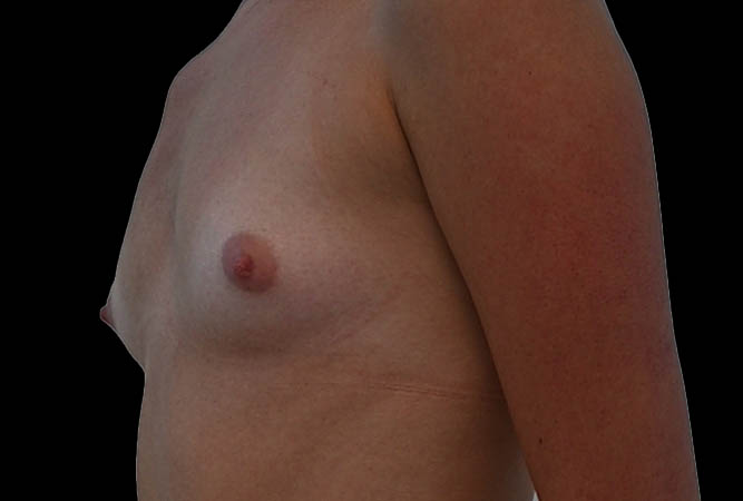 Breast Augmentation Before & After Image