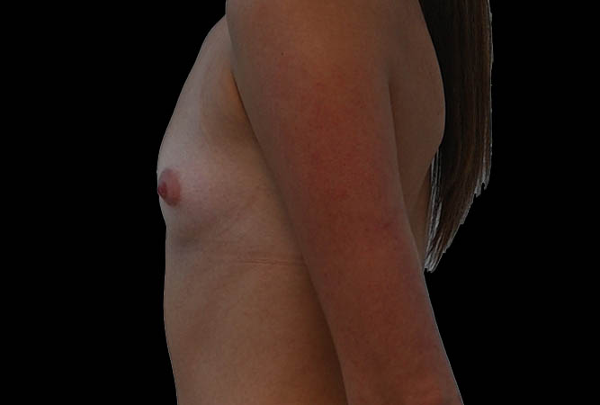 Breast Augmentation Before & After Image