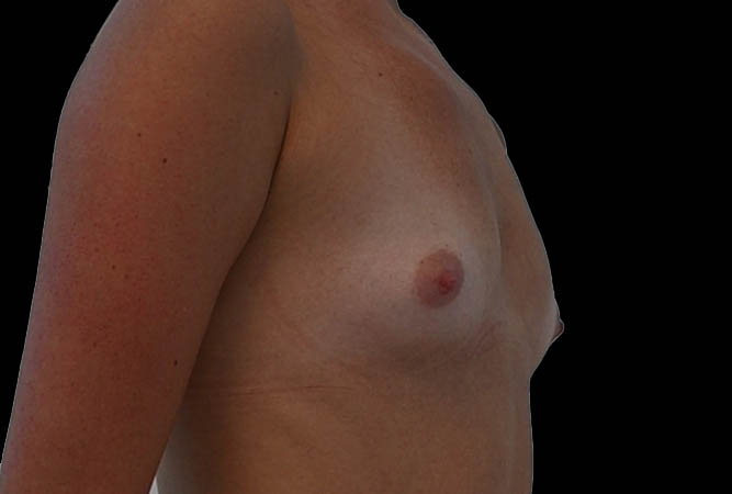 Breast Augmentation Before & After Image