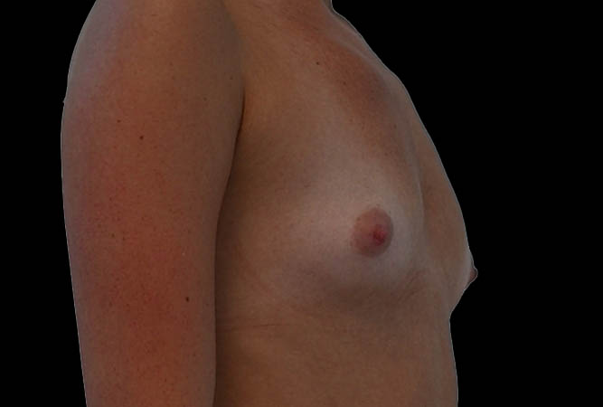 Breast Augmentation Before & After Image