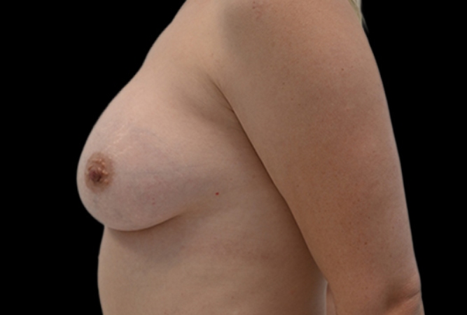 Breast Augmentation Before & After Image
