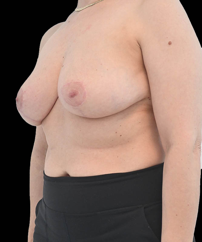 Breast Reduction and Lift Before & After Image
