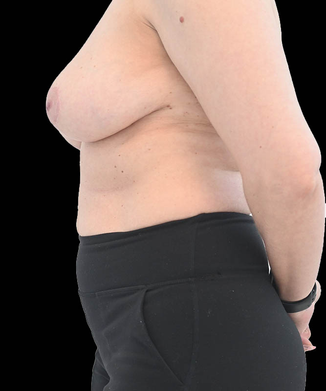 Breast Reduction and Lift Before & After Image