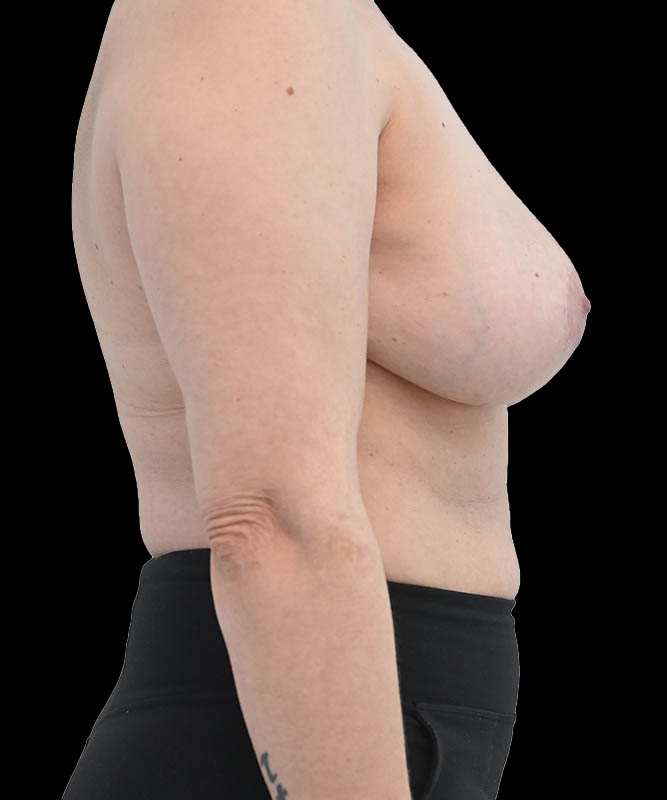 Breast Reduction and Lift Before & After Image