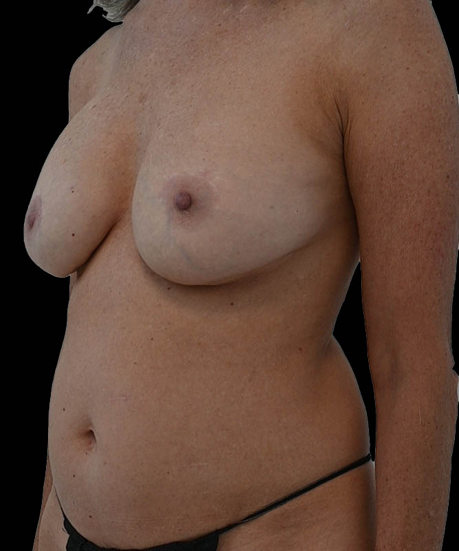 Cosmetic Flap Augmentation Before & After Image