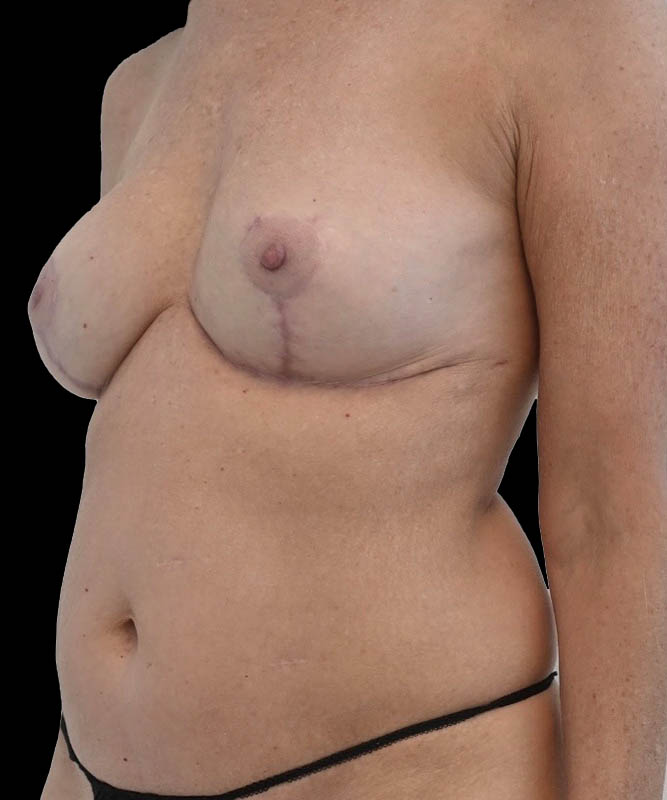 Cosmetic Flap Augmentation Before & After Image