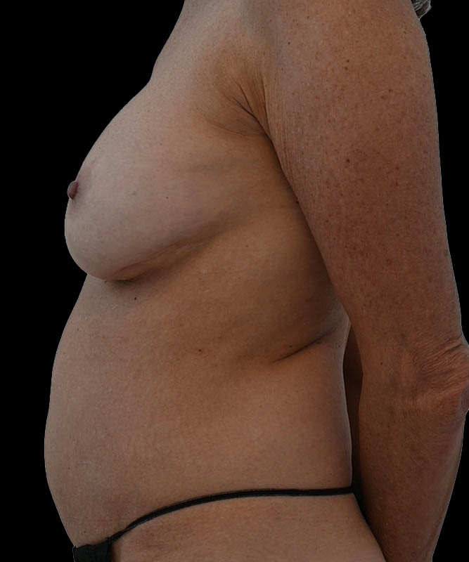 Cosmetic Flap Augmentation Before & After Image