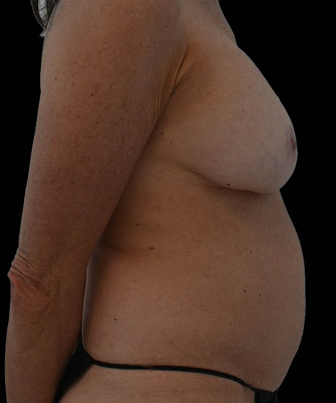 Cosmetic Flap Augmentation Before & After Image