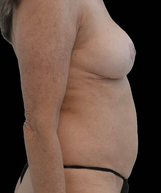 Cosmetic Flap Augmentation Before & After Image