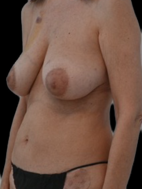 Delayed Hybrid Flap Reconstruction Before & After Image