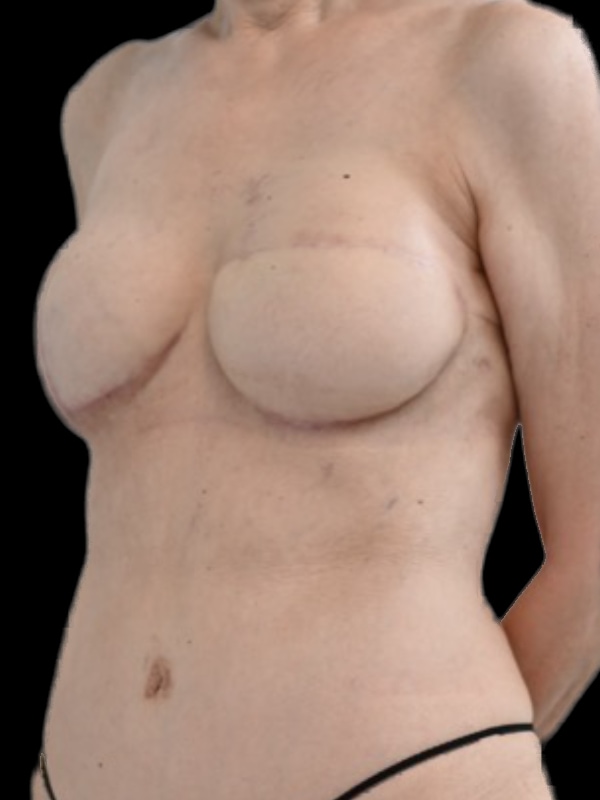 Delayed Hybrid Flap Reconstruction Before & After Image