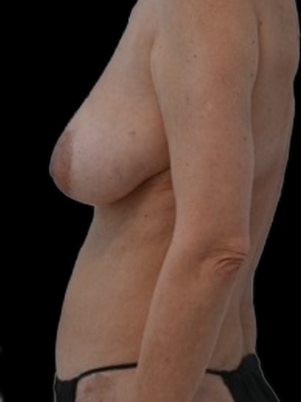 Delayed Hybrid Flap Reconstruction Before & After Image