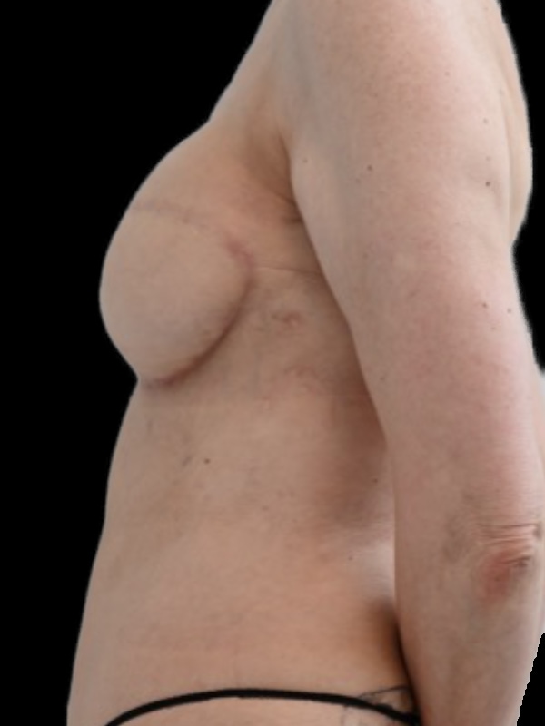 Delayed Hybrid Flap Reconstruction Before & After Image