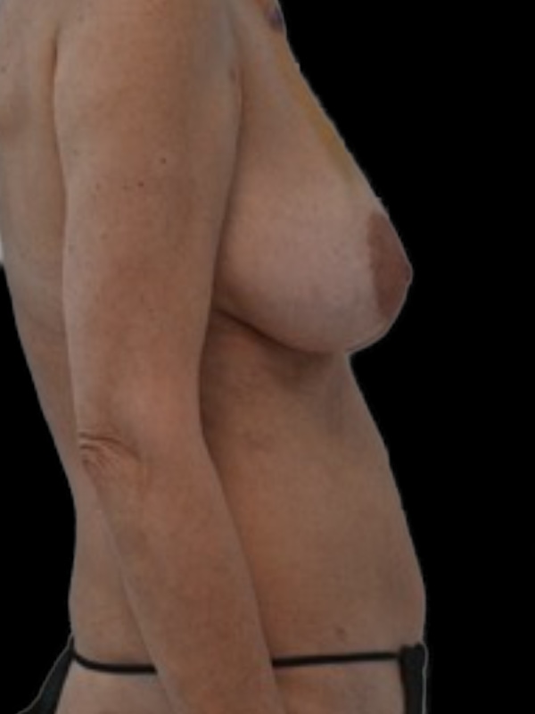 Delayed Hybrid Flap Reconstruction Before & After Image