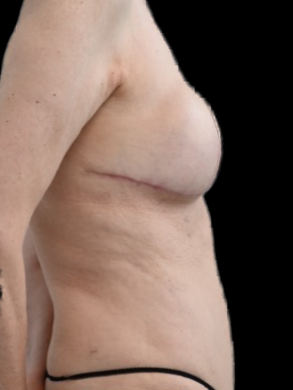 Delayed Hybrid Flap Reconstruction Before & After Image
