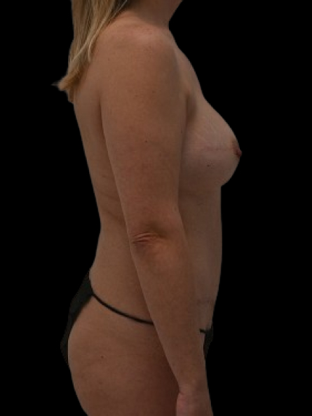 Delayed Reconstruction Before & After Image