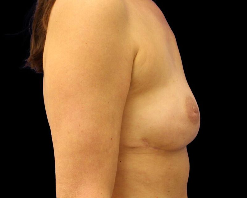 Delayed Reconstruction Before & After Image