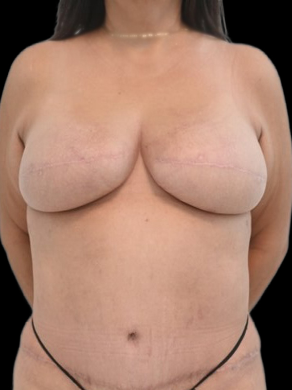Delayed Reconstruction Before & After Image