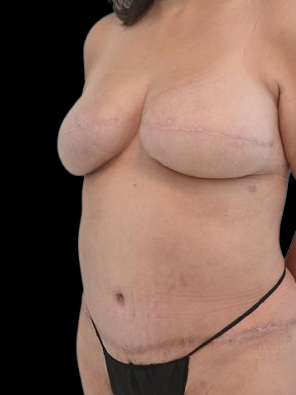 Delayed Reconstruction Before & After Image