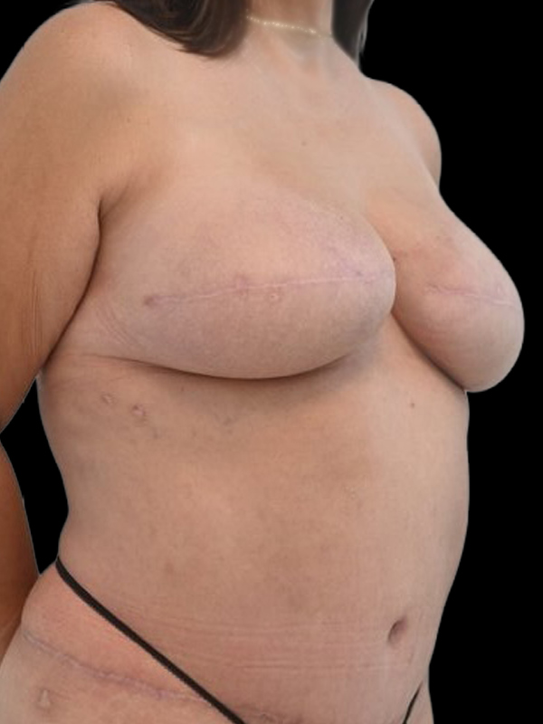 Delayed Reconstruction Before & After Image