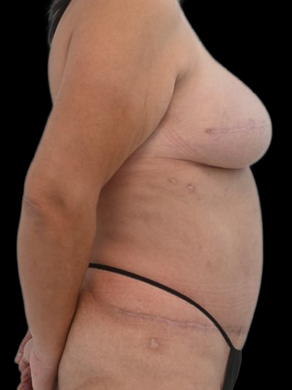 Delayed Reconstruction Before & After Image