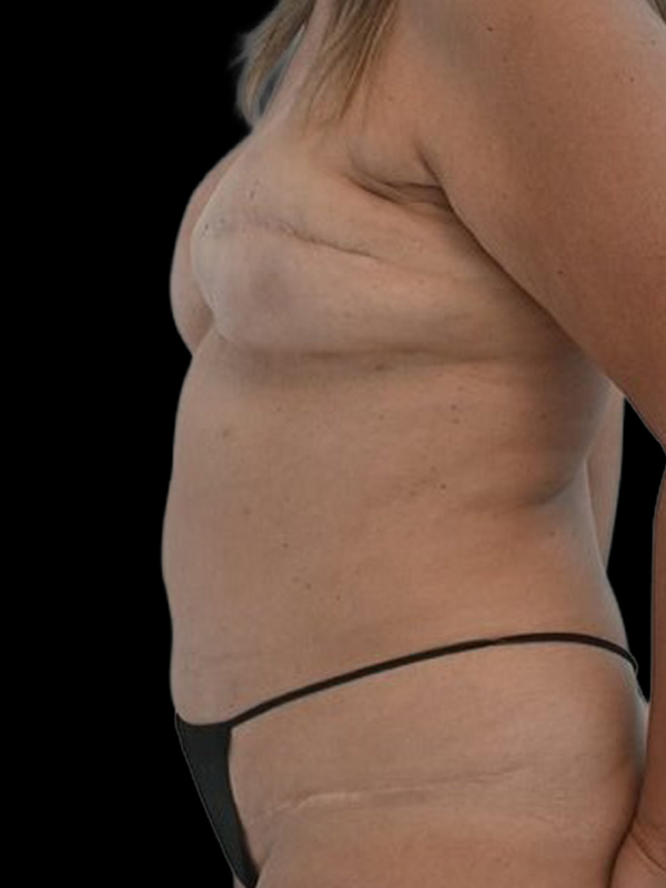 Delayed Reconstruction Before & After Image