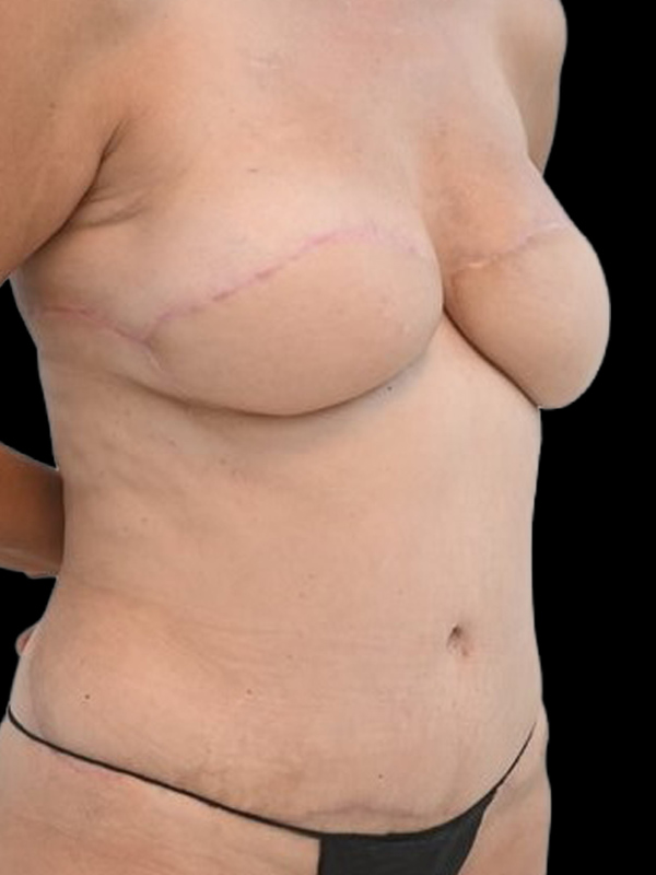 Delayed Reconstruction Before & After Image