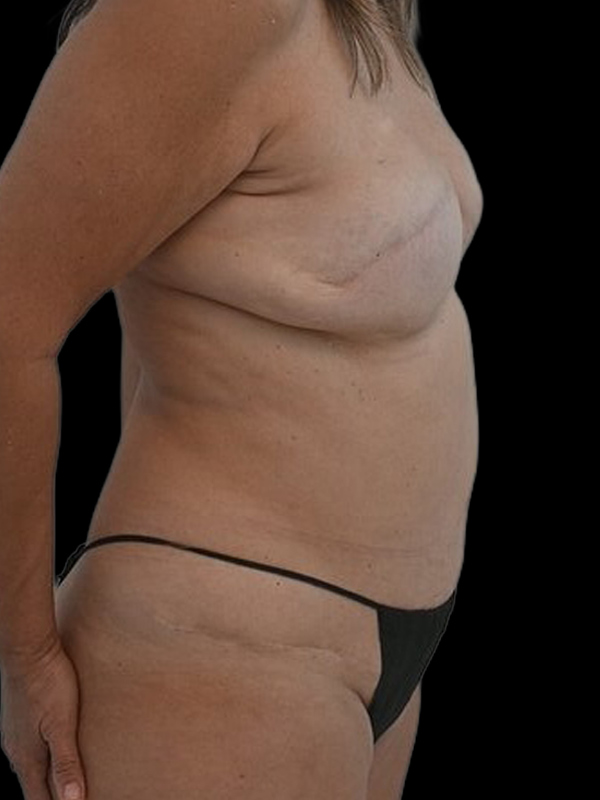 Delayed Reconstruction Before & After Image