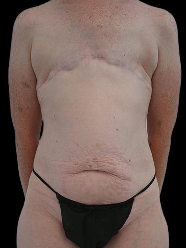 Delayed Reconstruction Before & After Image