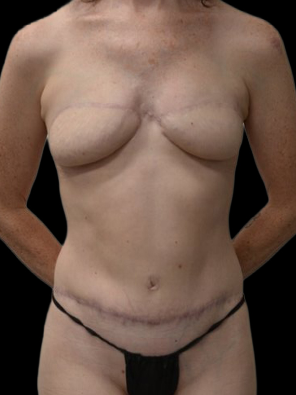 Delayed Reconstruction Before & After Image