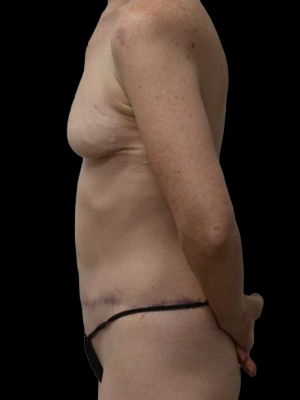 Delayed Reconstruction Before & After Image