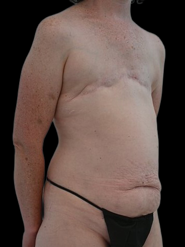 Delayed Reconstruction Before & After Image