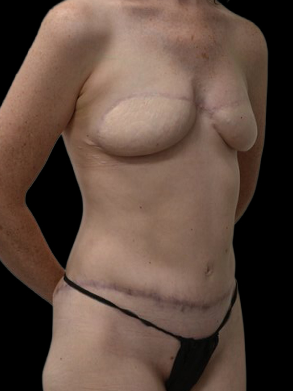 Delayed Reconstruction Before & After Image