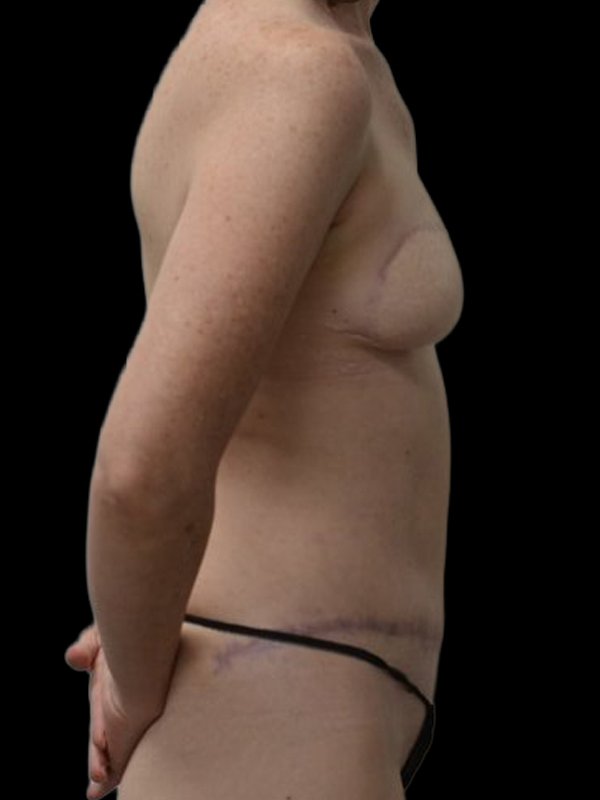 Delayed Reconstruction Before & After Image