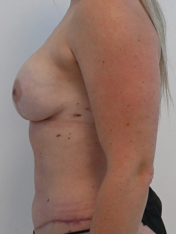 DIEP Flap Implant Hybrid Based Reconstruction Before & After Image