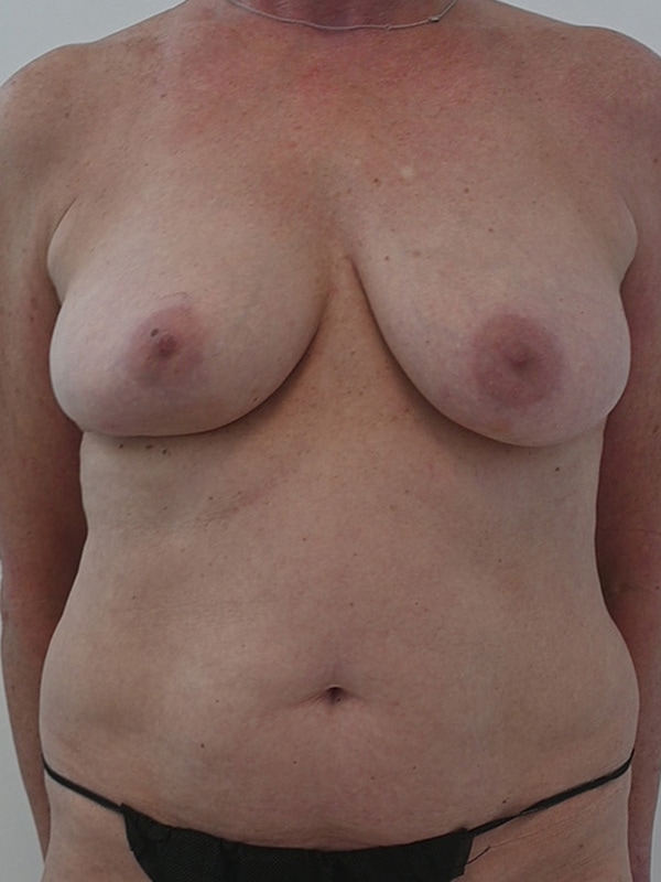 DIEP Flap Implant Hybrid Based Reconstruction Before & After Image