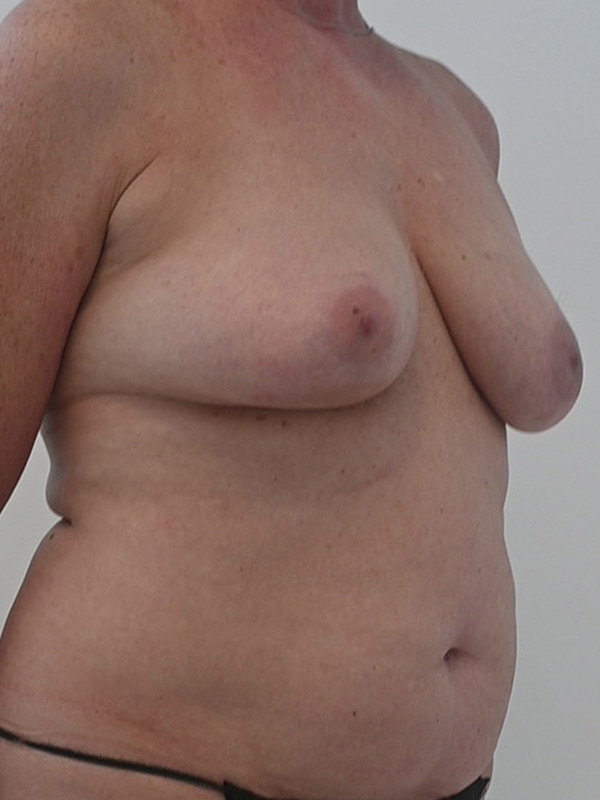 DIEP Flap Implant Hybrid Based Reconstruction Before & After Image