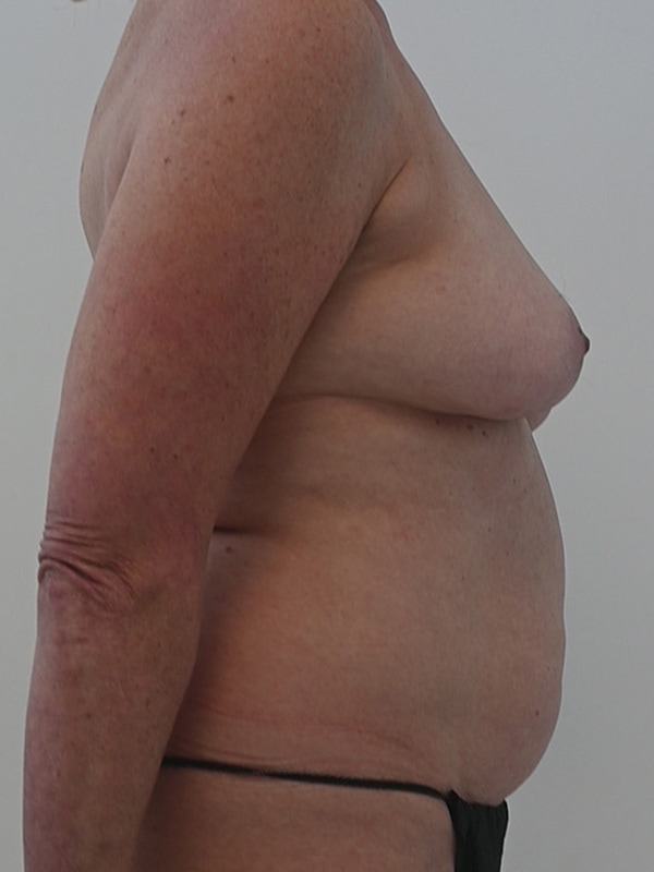 DIEP Flap Implant Hybrid Based Reconstruction Before & After Image