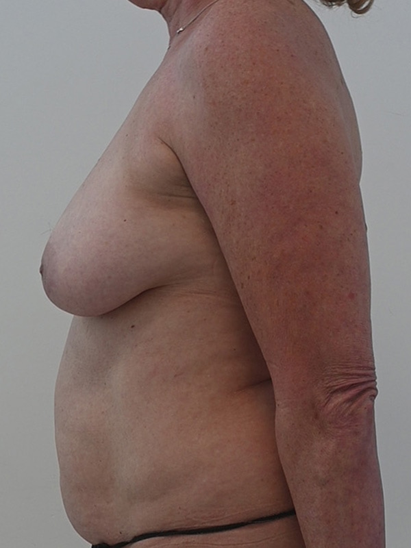 DIEP Flap Implant Hybrid Based Reconstruction Before & After Image