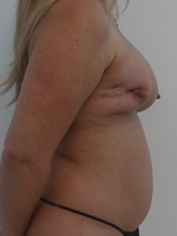 DIEP Flap Implant Hybrid Based Reconstruction Before & After Image